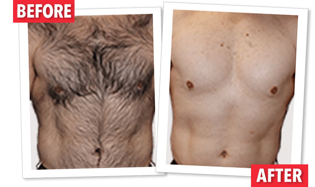 Side-by-side images show a "Before" and "After" comparison of a man's chest and abdomen. "Before" depicts a very hairy chest and abdomen, while "After" depicts a hairless, smooth chest and abdomen. The images are labeled with red text.