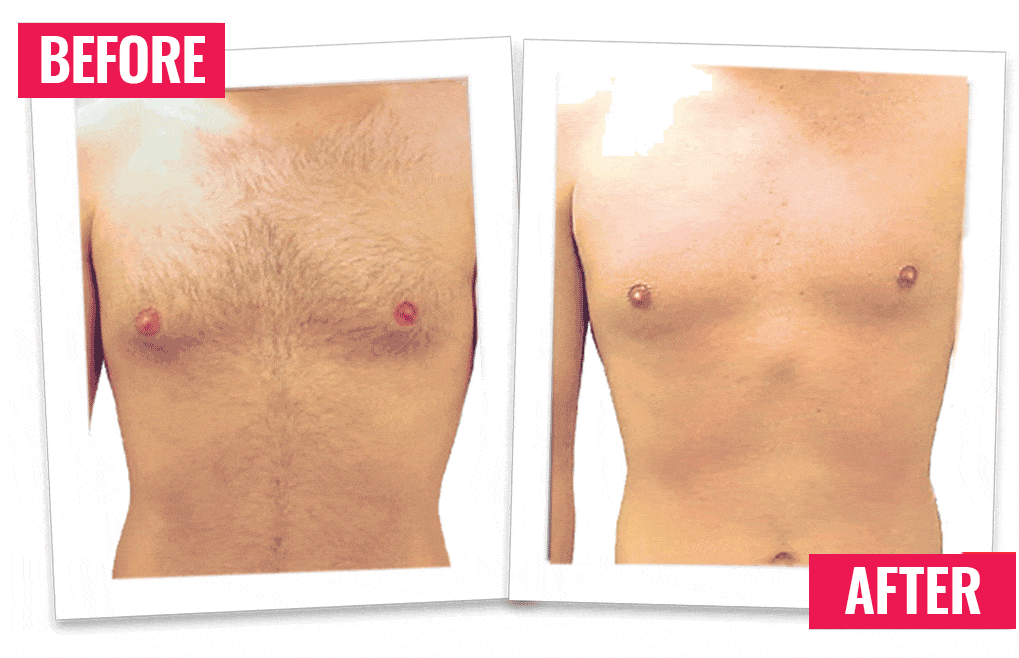 A split image showing a comparison of a man's bare chest before and after hair removal. The "Before" photo on the left shows a chest with noticeable body hair, while the "After" photo on the right shows a smooth and hair-free chest. Both images have "BEFORE" and "AFTER" labels in red boxes.